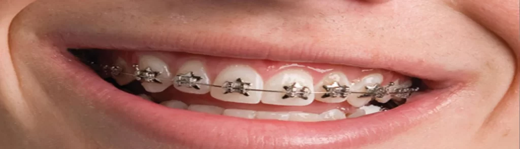 #Explained Orthodontic Treatment