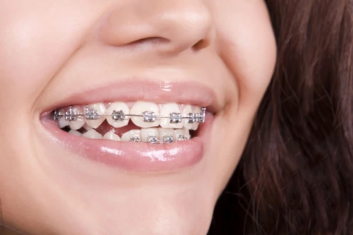 #Explained Orthodontic Treatment