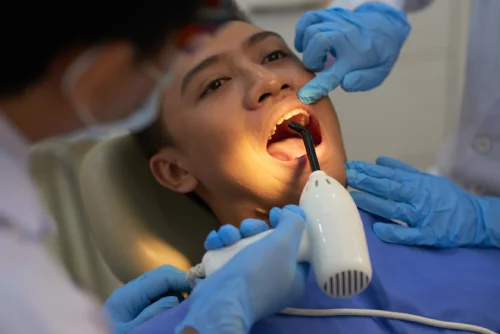 How Much Does Root Canal Treatment Cost in Pune